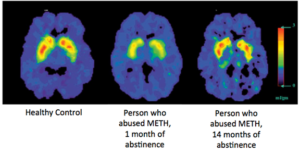 HUMAN BRAIN ON METH