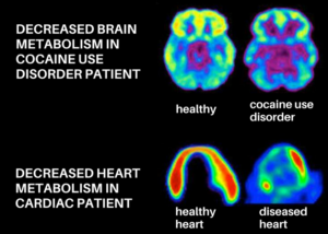 Healthy brain images compared to cocaine abuser brain