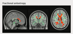 Moderate alcohol consumption as risk factor for adverse brain outcomes and cognitive decline: longitudinal cohort study.