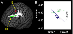 IMAGES OF THE TEEN BRAIN ON CANNABIS OR MARIJUANA