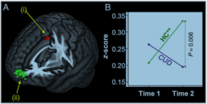 IMAGES OF THE BRAIN ON CANNABIS OR MARIJUANA