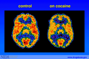 HUMAN BRAIN ON COCAINE