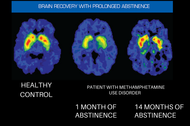 The Brain in Recovery – Recovery Research Institute