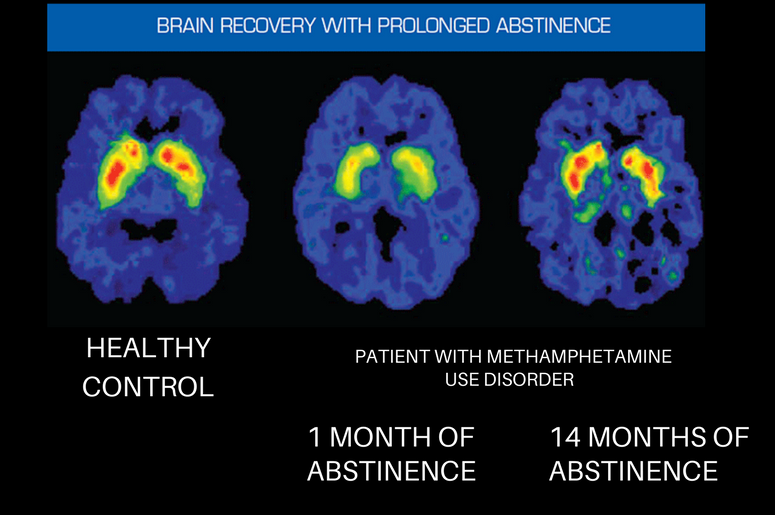 3 Key Points To Understand The Brain And Addiction Kill Addiction