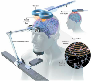 rTMS (repetitive transcranial magnetic stimulation): activating or suppressing activity in a specific brain site by holding a magnet (AKA electromagnetic coil) against the head