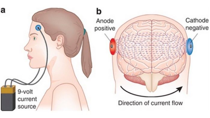 Deep Brain stimulation - Two small electrodes are placed on either side of a specific brain structure
